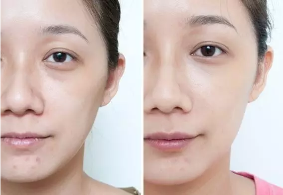 双眼皮看起来又宽又假?有可能是你眼窝凹陷_苏州美莱整形美容医院