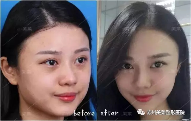 真人案例，长得这么好看还来打玻尿酸，是不是作?