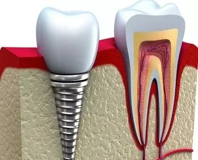 种牙最好的方案 4744_170602101328_1.jpg